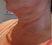 Picture of neck after session 2