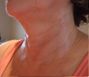 Picture of neck after session 6